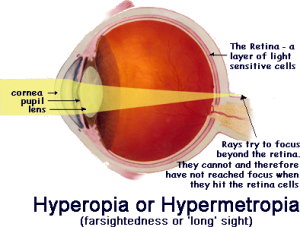 Eye Herpes or Ocular Herpes - AllAboutVision.com